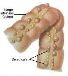  become infected or inflamed, the condition is called DIVERTICULITIS ...